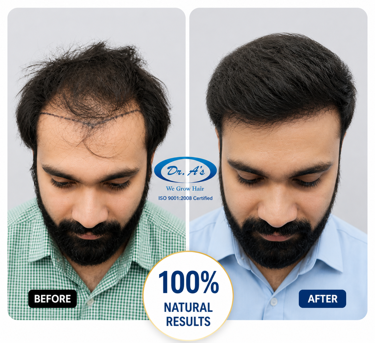 hair transplanr result 1