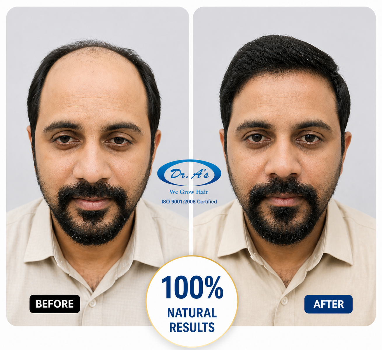 hair transplanr result 2
