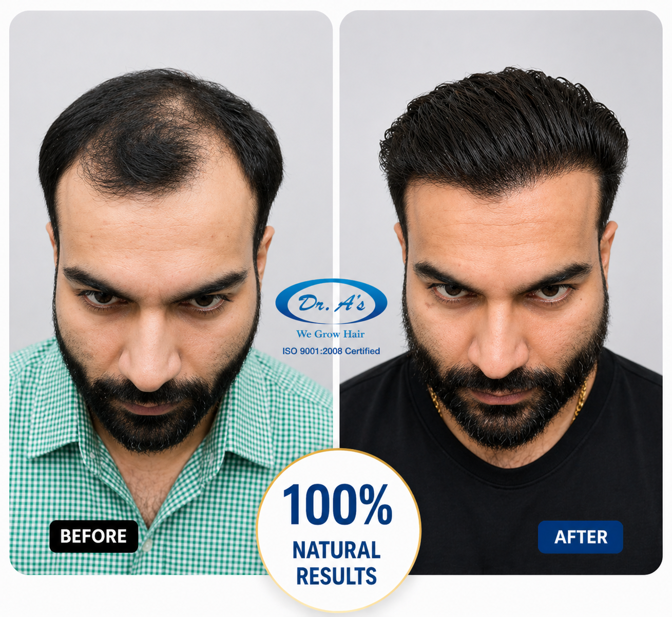 hair transplanr result 3