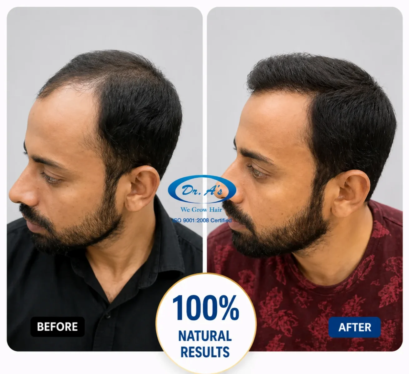 hair-transplanr-result-4