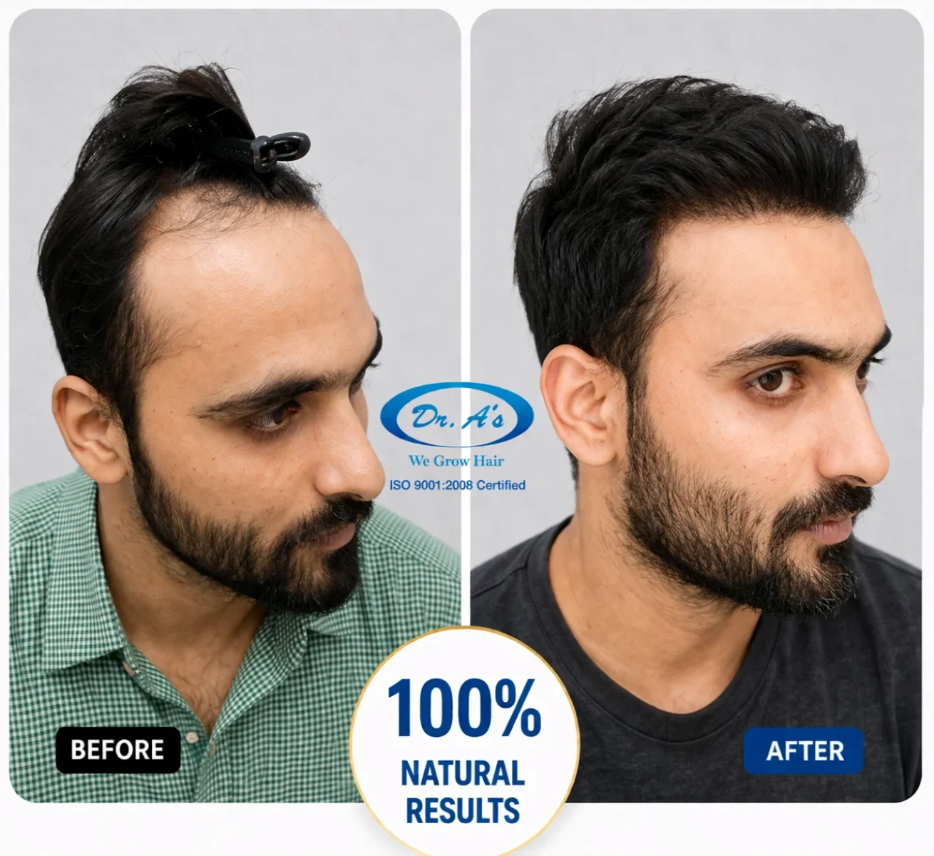 hair-transplanr-result-5