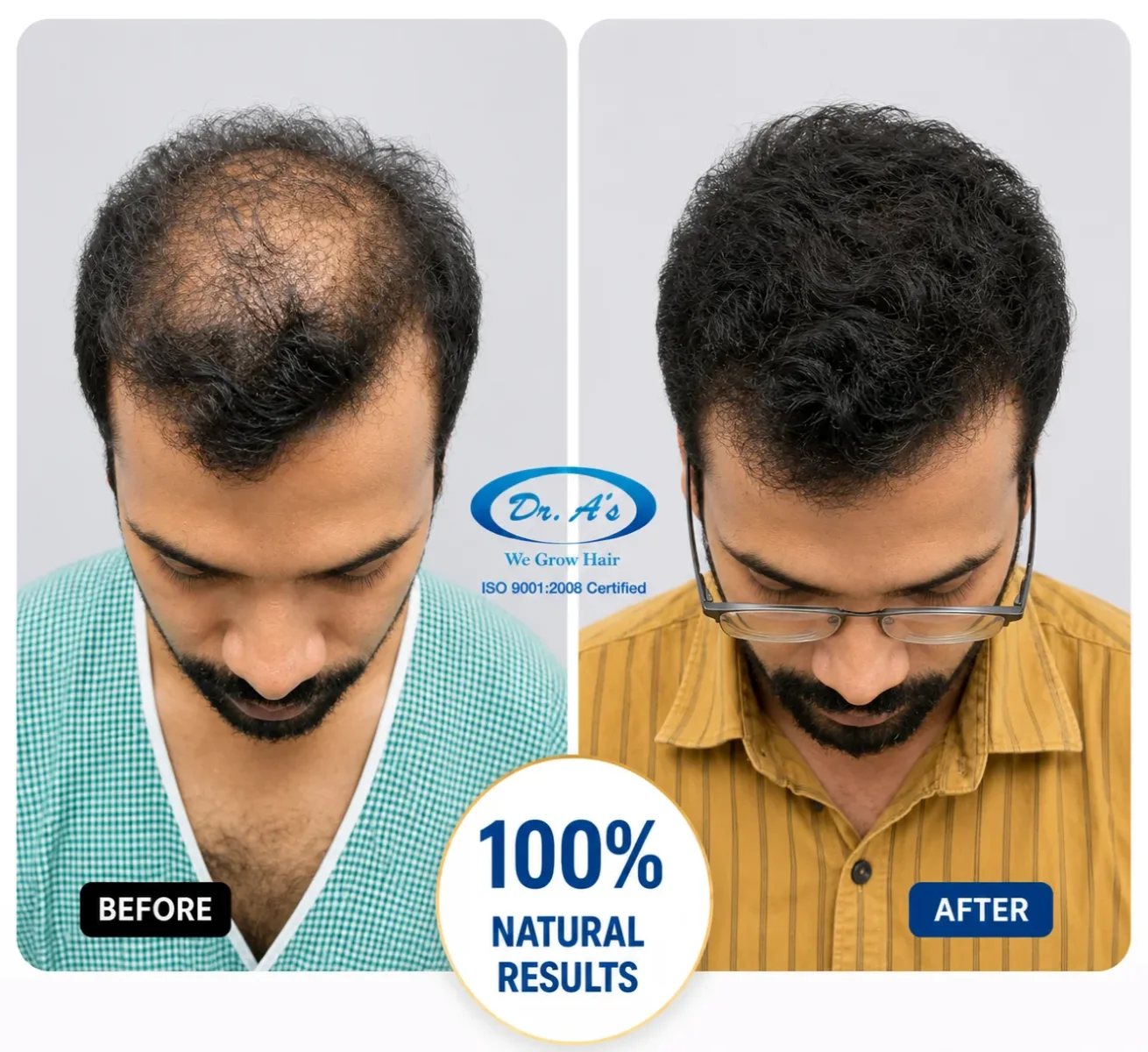 hair-transplanr-result-6
