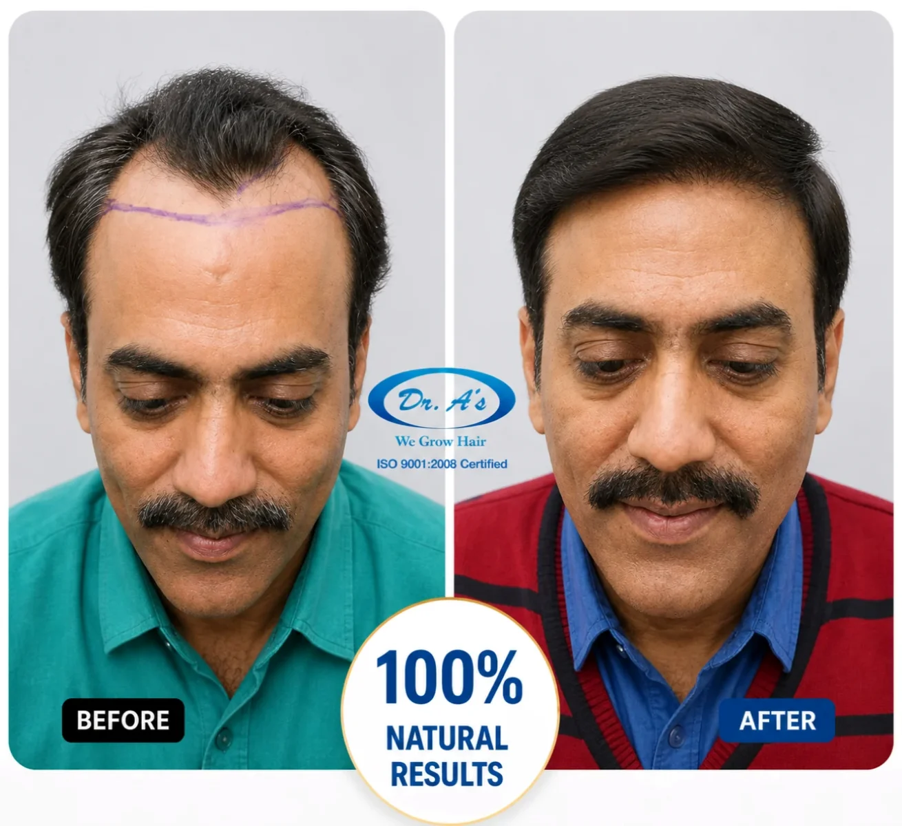hair-transplanr-result-7