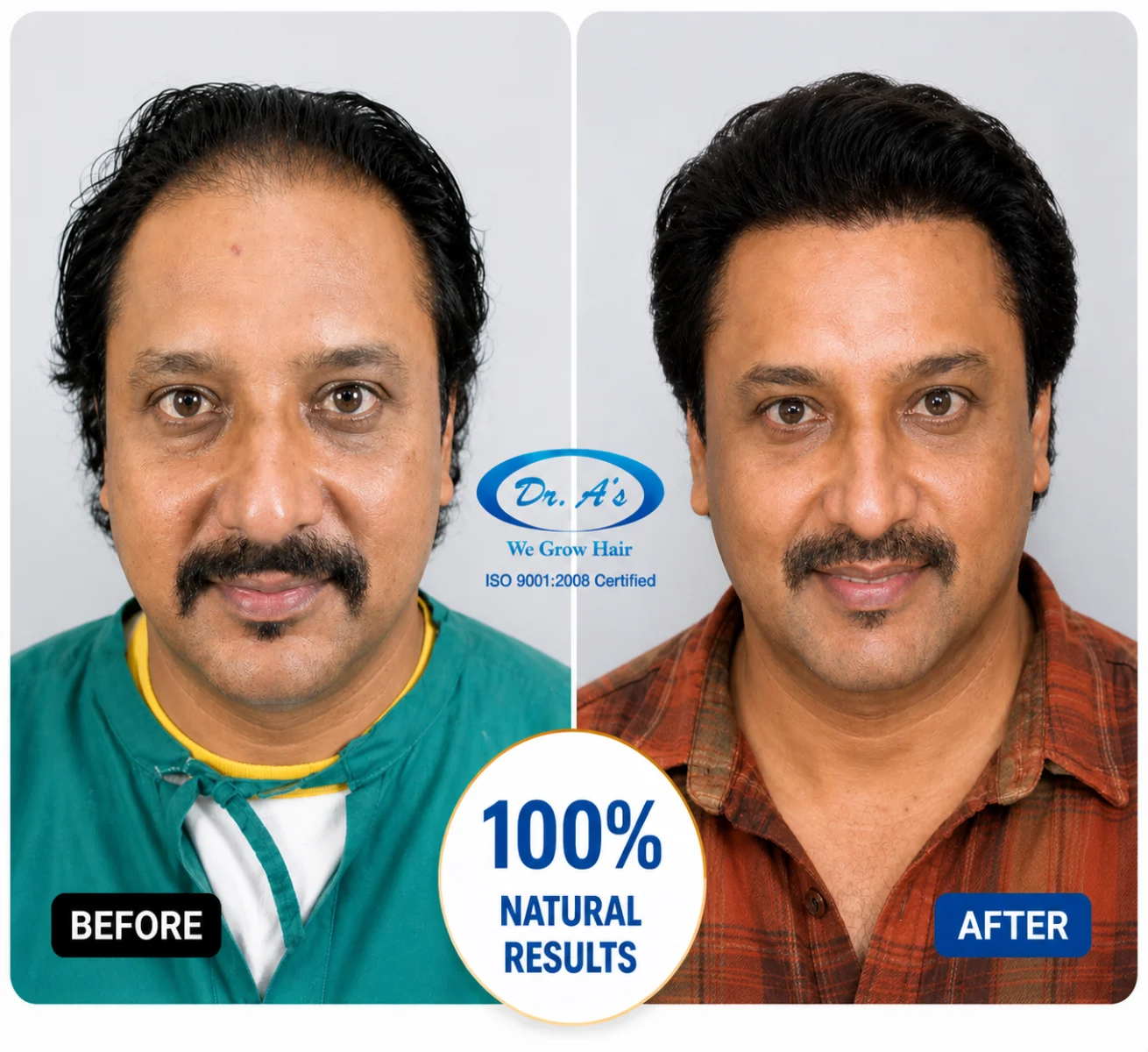 hair transplanr result 9