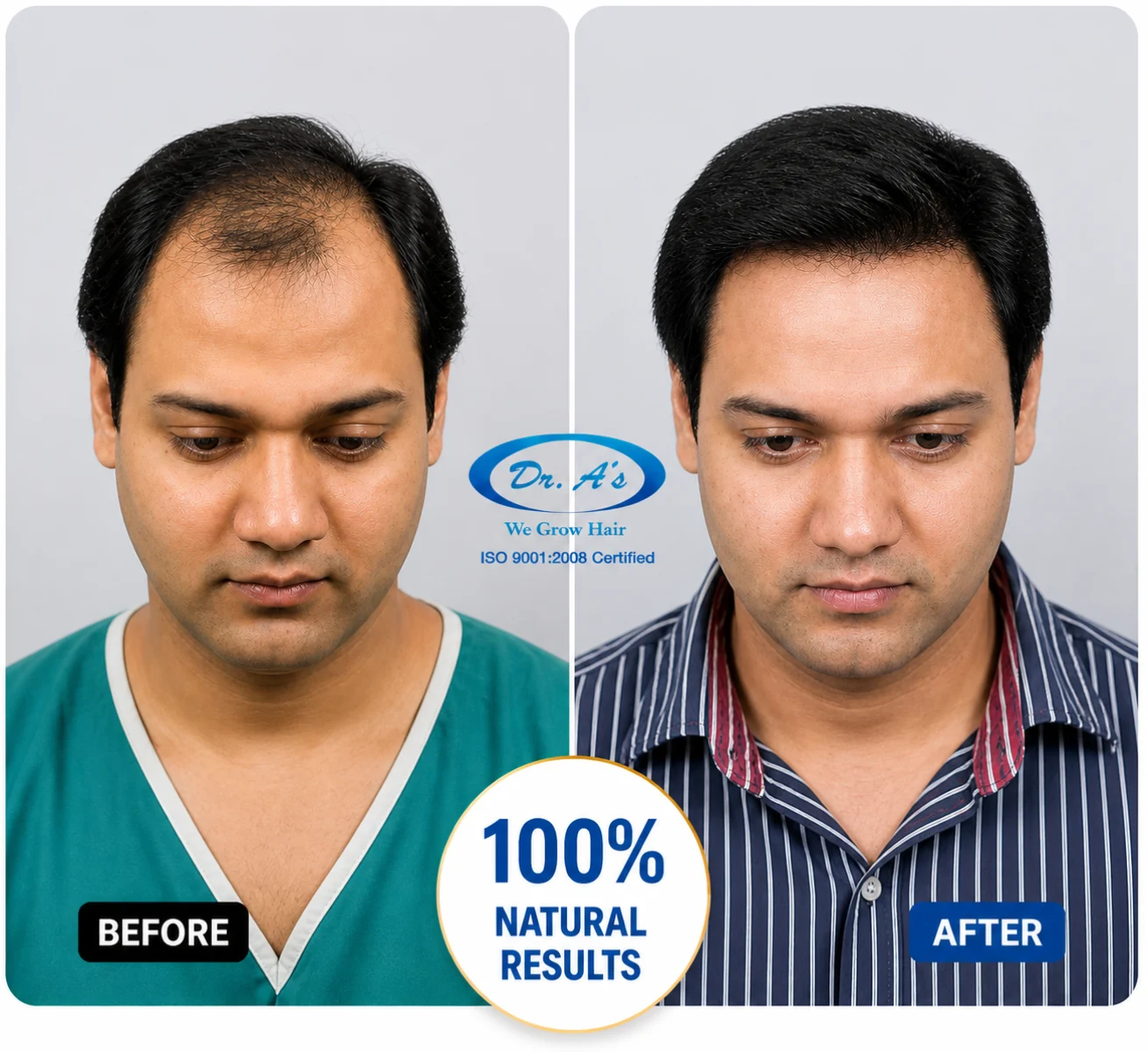 hair transplant result 8