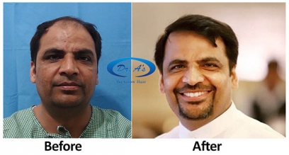 fue hair transplant in delhi