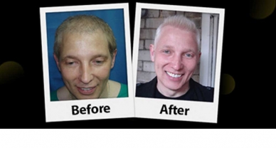 Repair Hair Transplant Photogallery